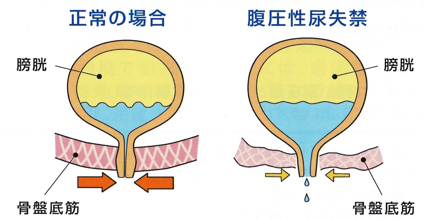 [女性]過活動膀胱以外にも尿のトラブルを引き起こす病気があります 北海道旭川市の神楽岡泌尿器科のブログ